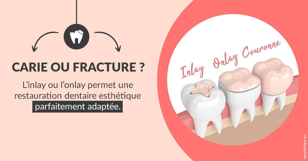 https://dr-mauger-benoit.chirurgiens-dentistes.fr/T2 2023 - Carie ou fracture 2