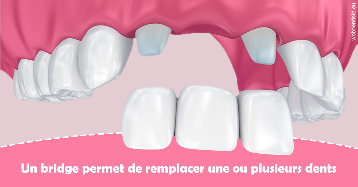 https://dr-mauger-benoit.chirurgiens-dentistes.fr/Bridge remplacer dents 2