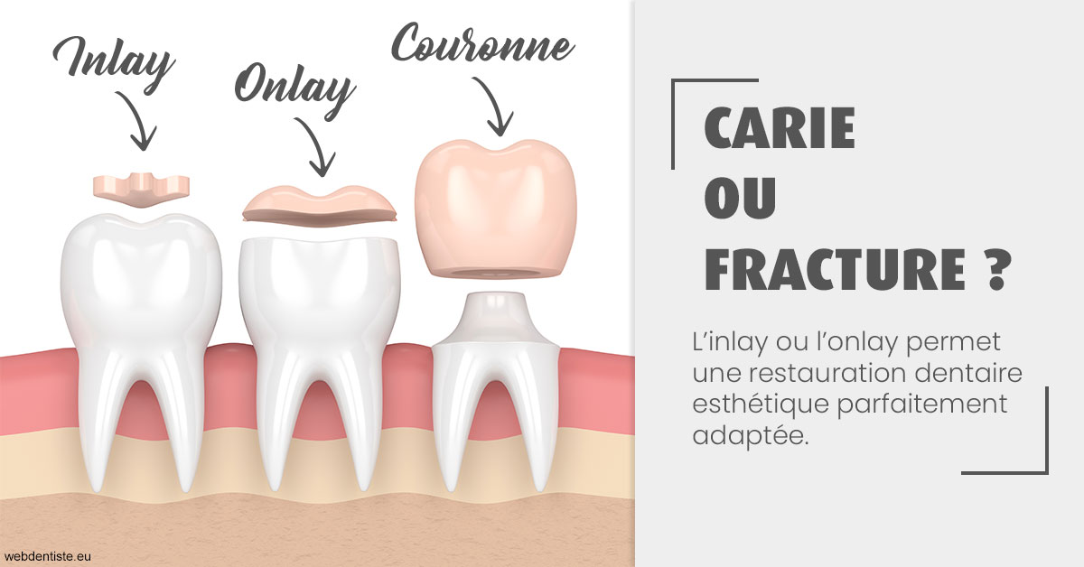https://dr-mauger-benoit.chirurgiens-dentistes.fr/T2 2023 - Carie ou fracture 1