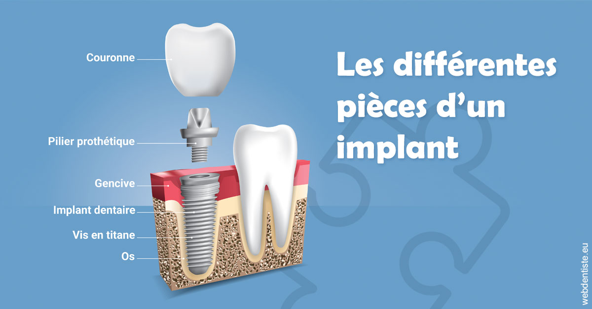 https://dr-mauger-benoit.chirurgiens-dentistes.fr/Les différentes pièces d’un implant 1