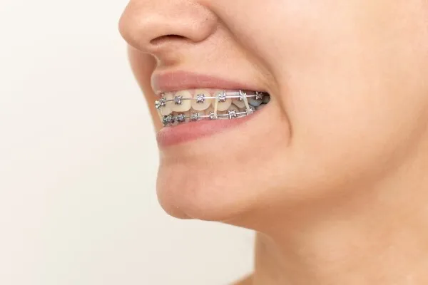 Elastiques en orthodontie