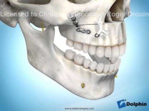 Chirurgie impaction maxillaire